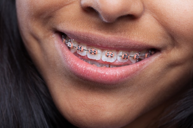 Metal Orthodontic Braces: The Tried and True Solution for Perfect Teeth Alignment - Bcrelx