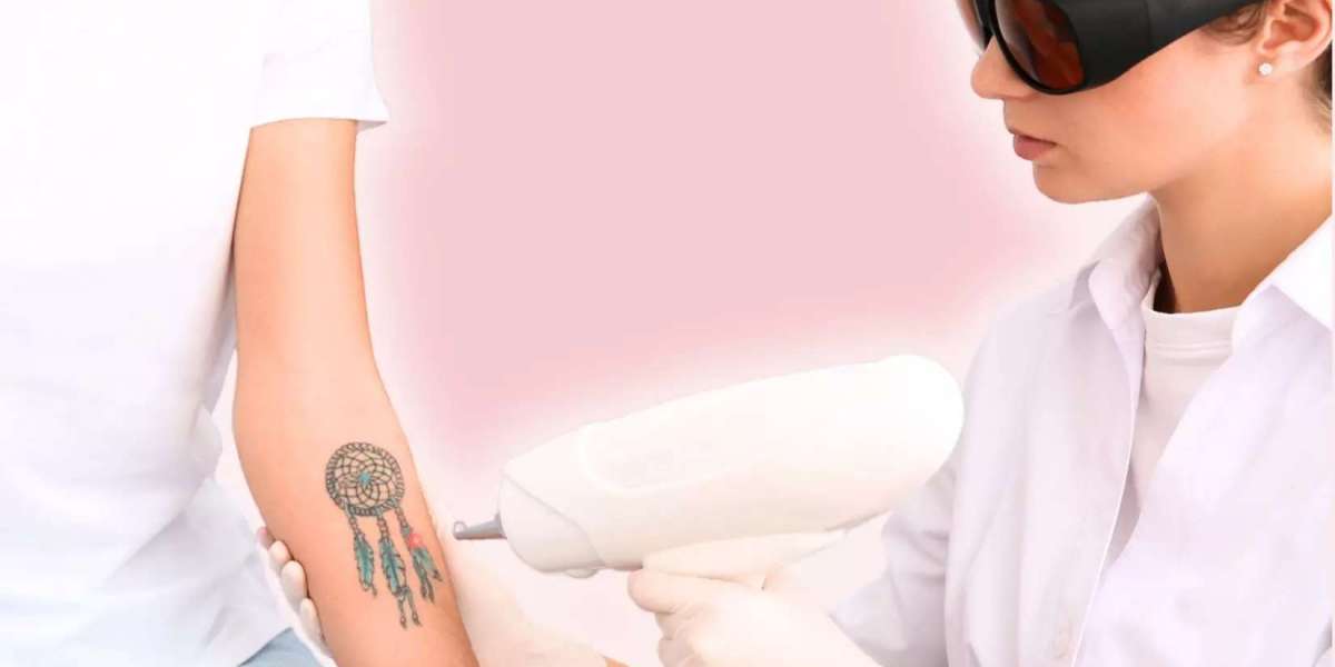 Laser Tattoo Removal Near Me Orlando