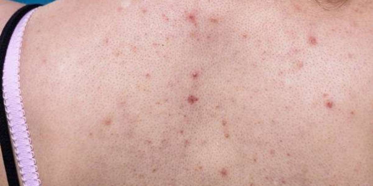 How to Treat Back Acne Without Expensive Treatments