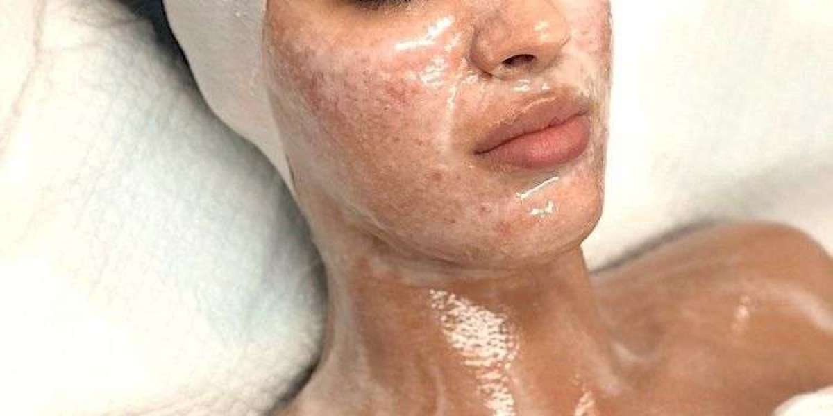 Enzyme Therapy for Uneven Skin Texture and Tone