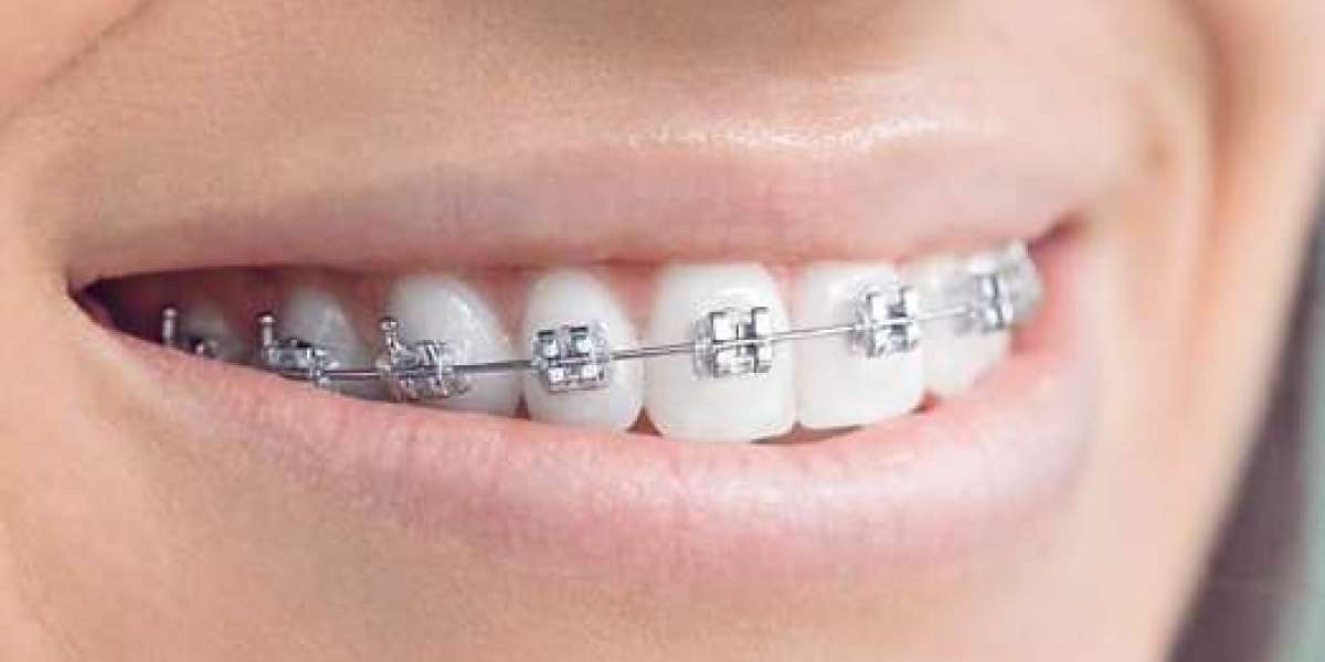Are Metal Braces Safe for Sensitive Teeth?