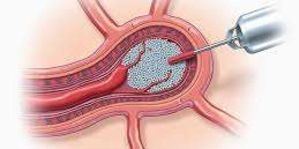 Relief from Hemorrhoids Understanding Hemorrhoid Embolization