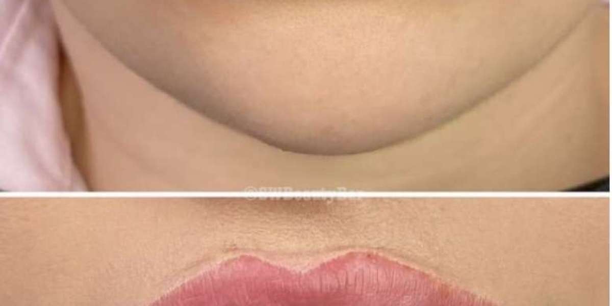 Lippen aufspritzen im Herzen von Zürich – natürlich schön und individuell perfekt