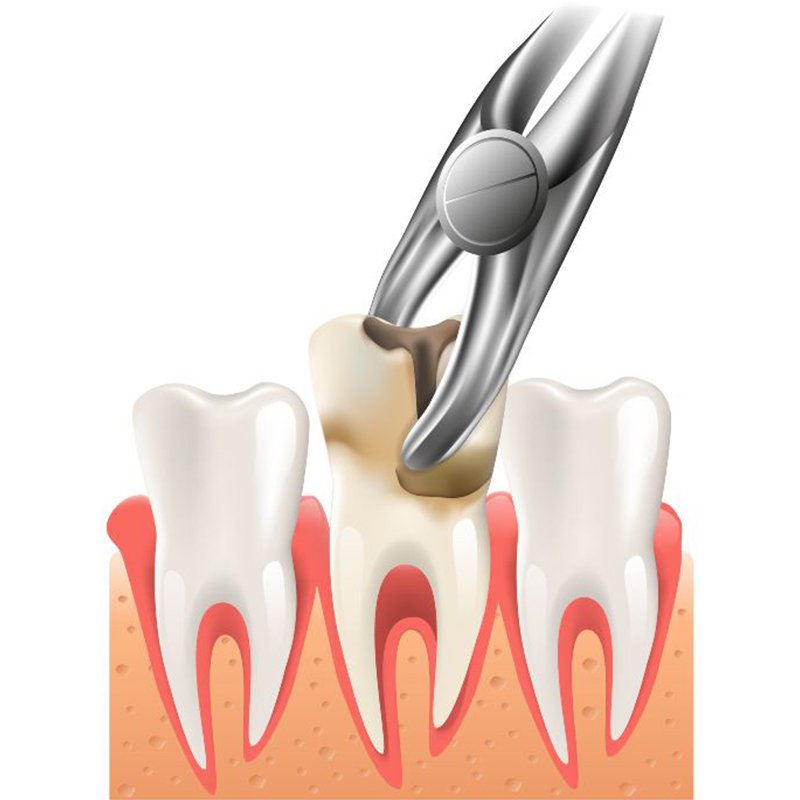 Best Tooth Extraction in Abu Dhabi | Safe & Gentle Removal