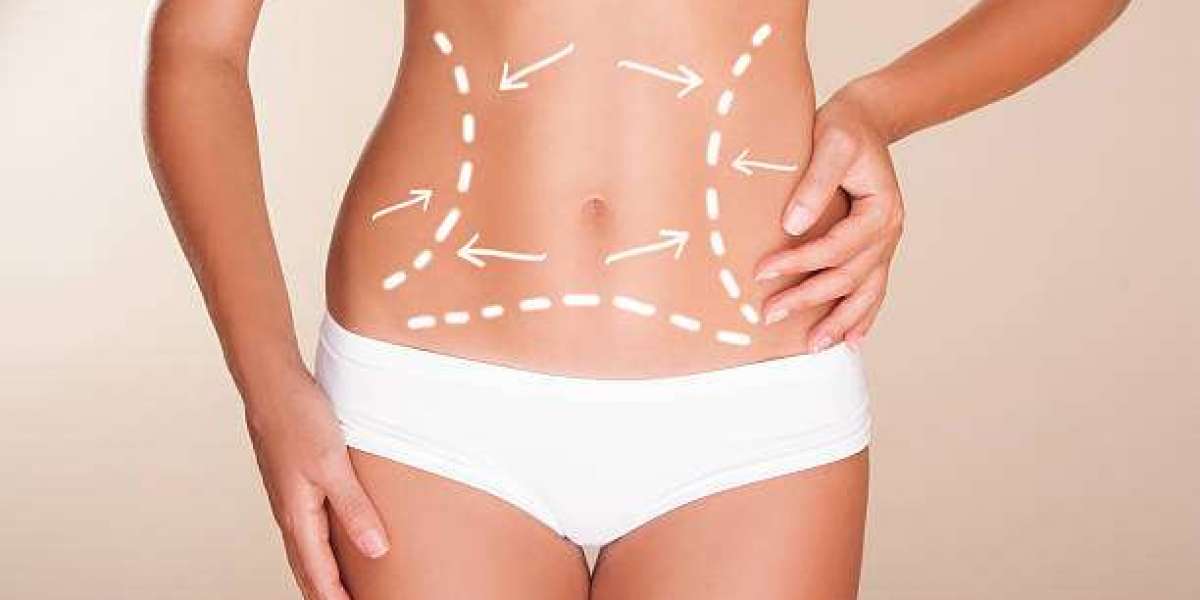 Expert Tips on Maintaining Results After Liposuction in Riyadh