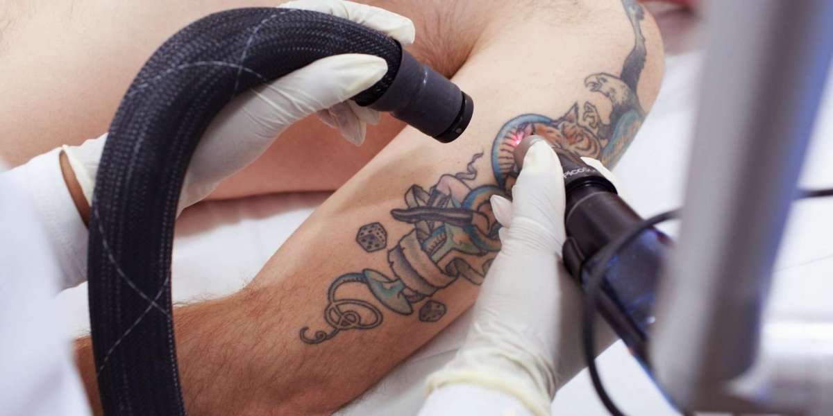 How much does tattoo removal cost in Islamabad?