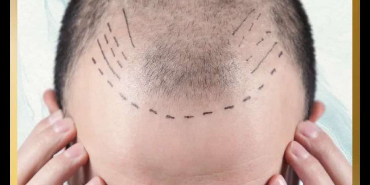 Hair Cloning Trends in Dubai: What’s Popular in 2025