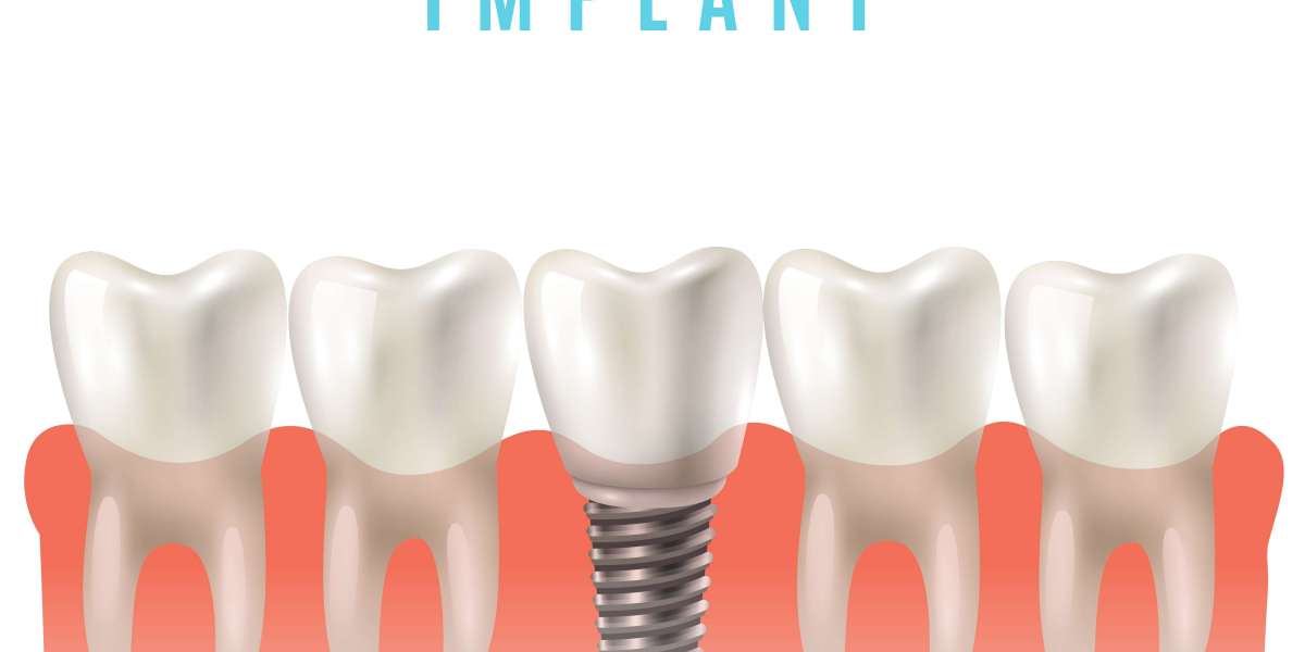 Dental Implants in South East London: A Modern Solution for Lasting Smiles