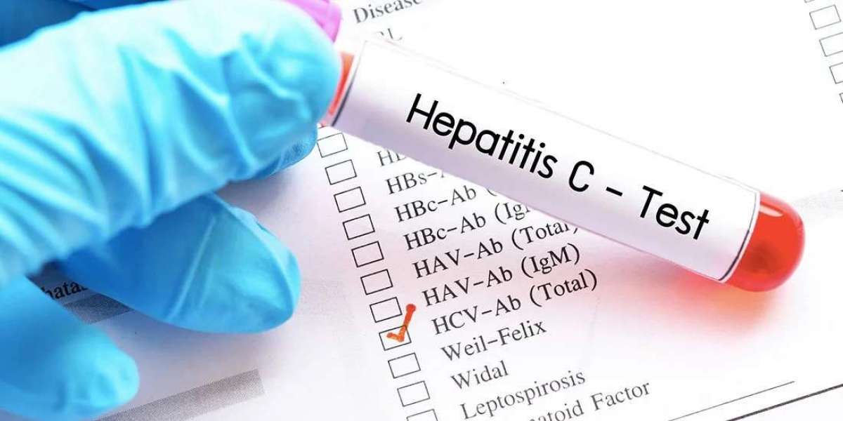 Anti-HCV Test: Detecting Hepatitis C Early for Better Health