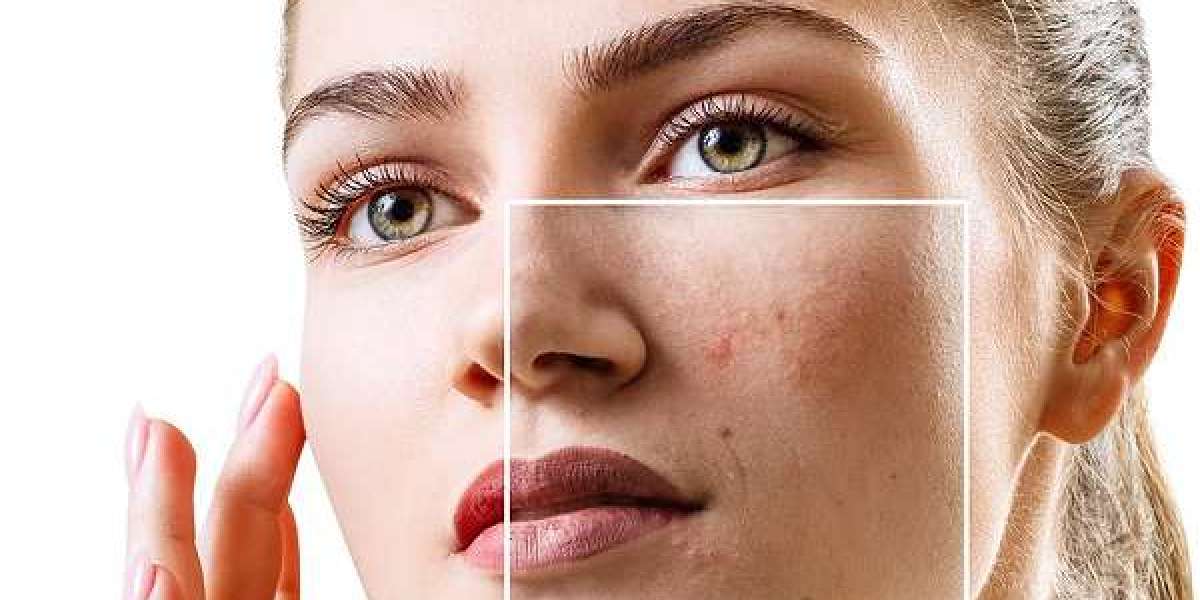 Dubai Acne Scar Treatments Clear Skin Without Surgery