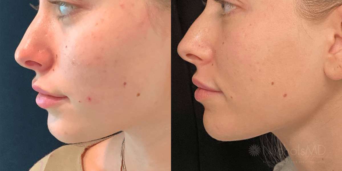 How Much Does PRP Therapy Cost in Dubai on Average?