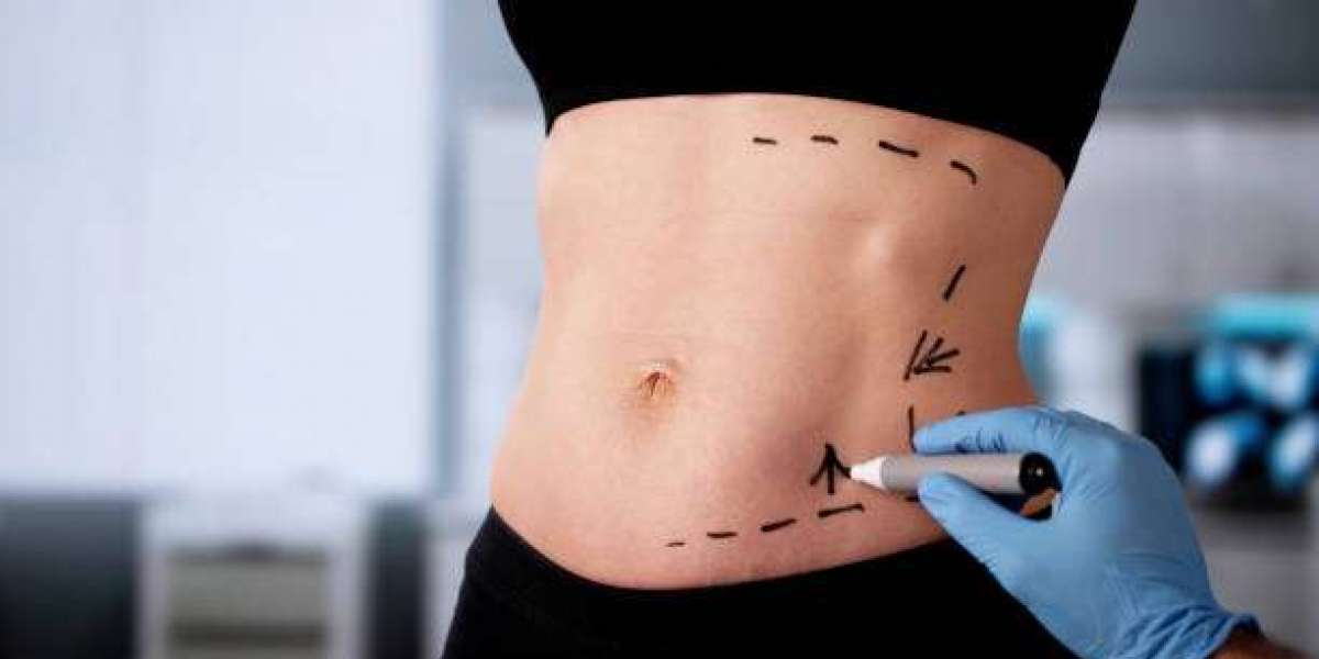 What Lifestyle Changes Support Tummy Tuck Results?