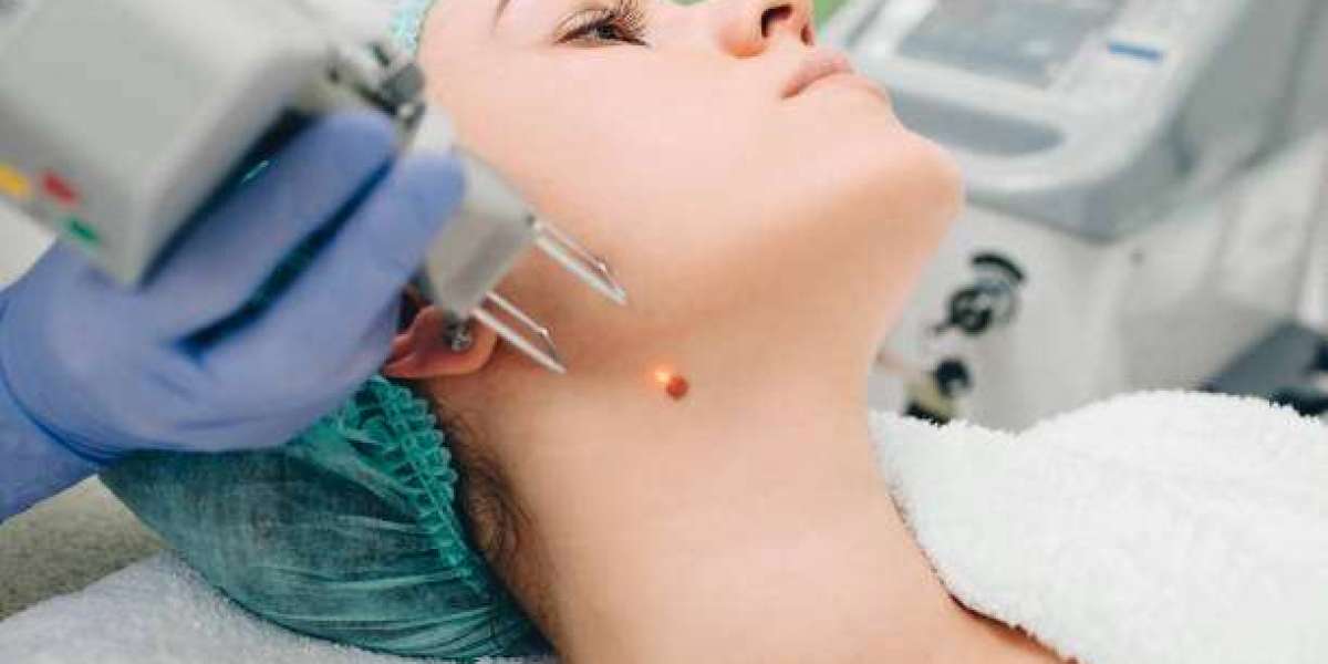 Wart Removal Boosts Confidence on Exposed Skin