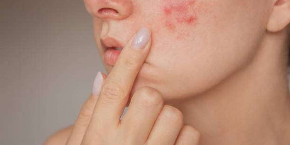Long-Term Results from Laser Acne Treatment Revealed