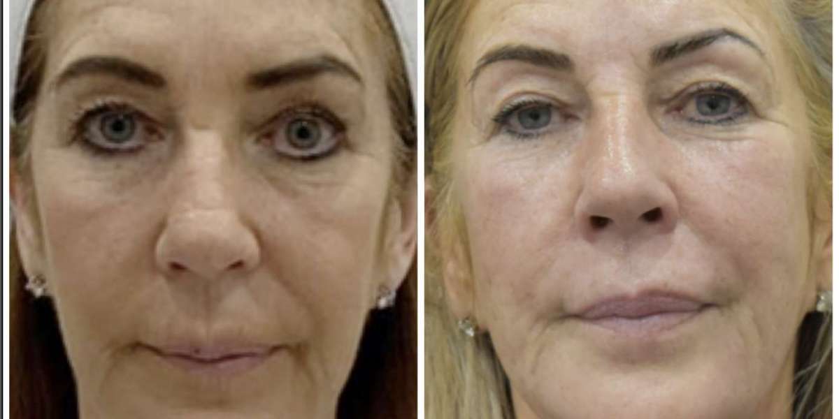 Radio Frequency Skin Tightening: Non-Surgical Skin Rejuvenation for a Youthful Glow
