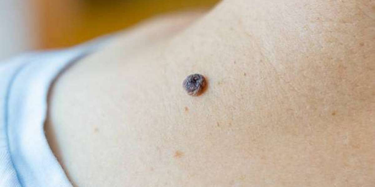 Expert Tips to Prepare for a Mole Removal Procedure