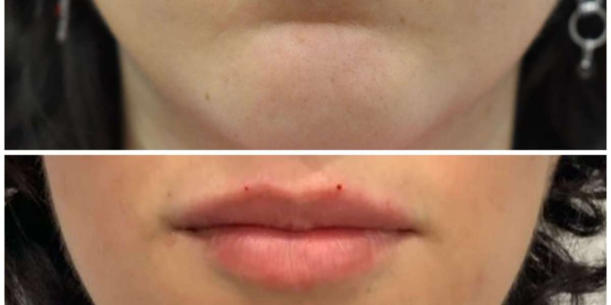 Dermal Fillers Leeds: Restore Youthful Volume and Enhance Facial Contours