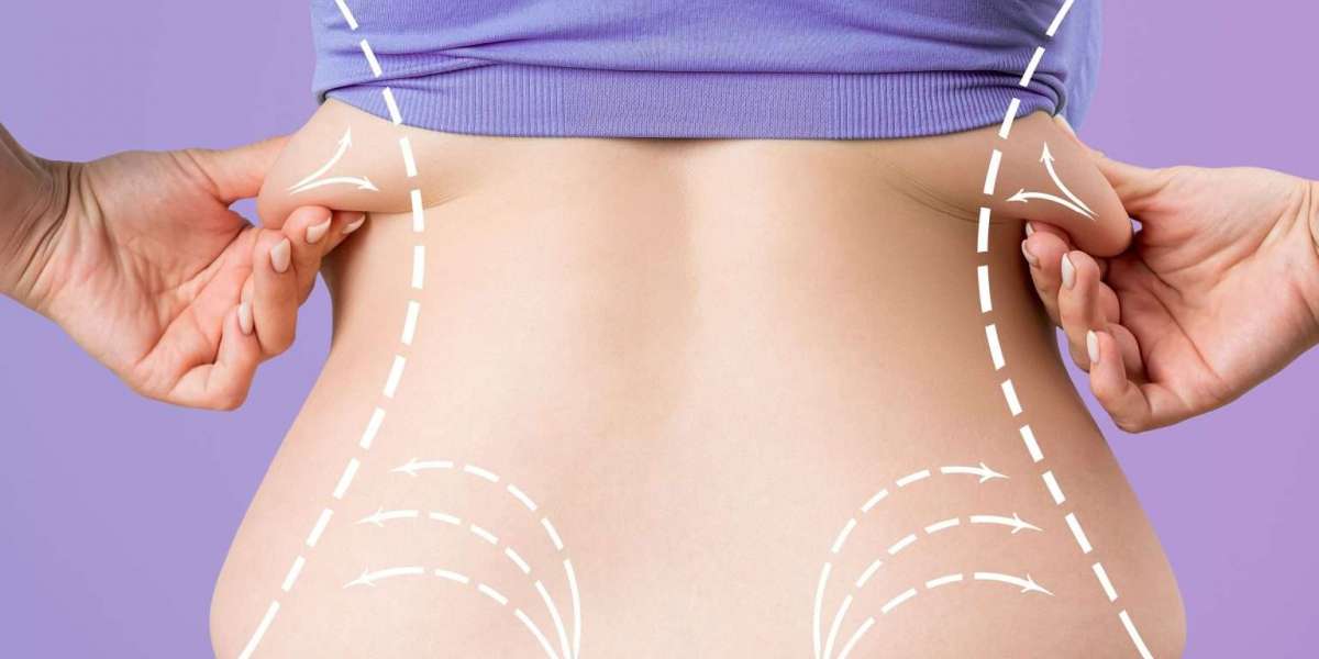 How Surgeons Sculpt Natural-Looking Results With Liposuction