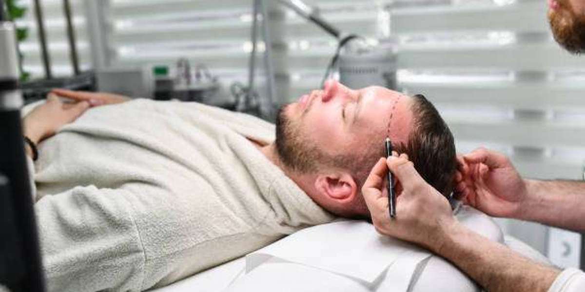 Hair Transplant: Recovery Tips for Optimal Results