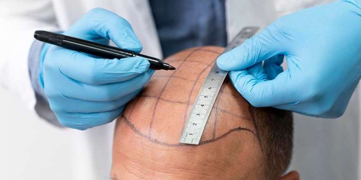 The Long-Lasting Benefits of Modern Hair Transplant Procedures