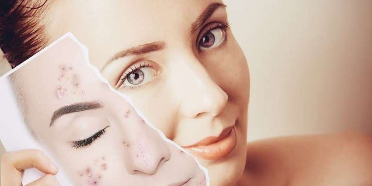 Acne Removal Dubai: Fast & Effective Methods