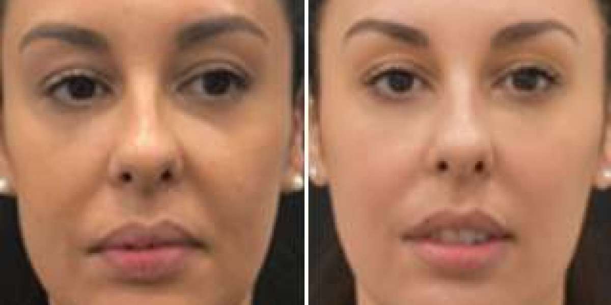 Tear Trough Filler Treatment: Rejuvenate Your Eyes and Restore a Youthful Look
