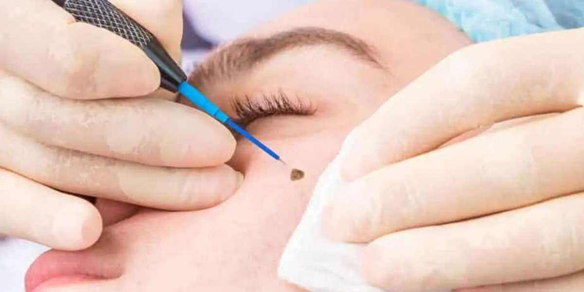 How to Prepare for a Mole Removal Procedure?