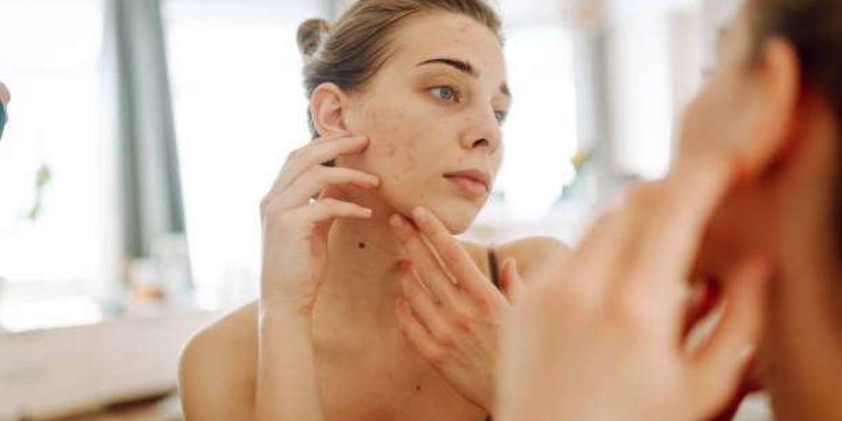 Holistic Pimples Treatment for Healthier Looking Skin