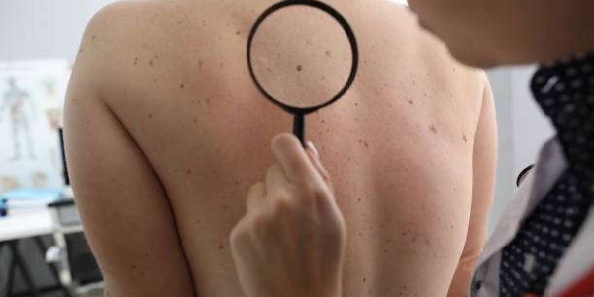 What to Expect Before and After Mole Removal Treatment
