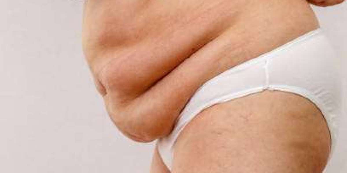 Holistic Lipedema Treatment Approaches for Long-Term Results