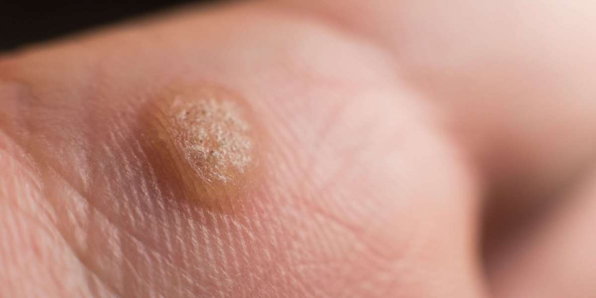 How Strong Should Salicylic Acid Be for Plantar Warts?