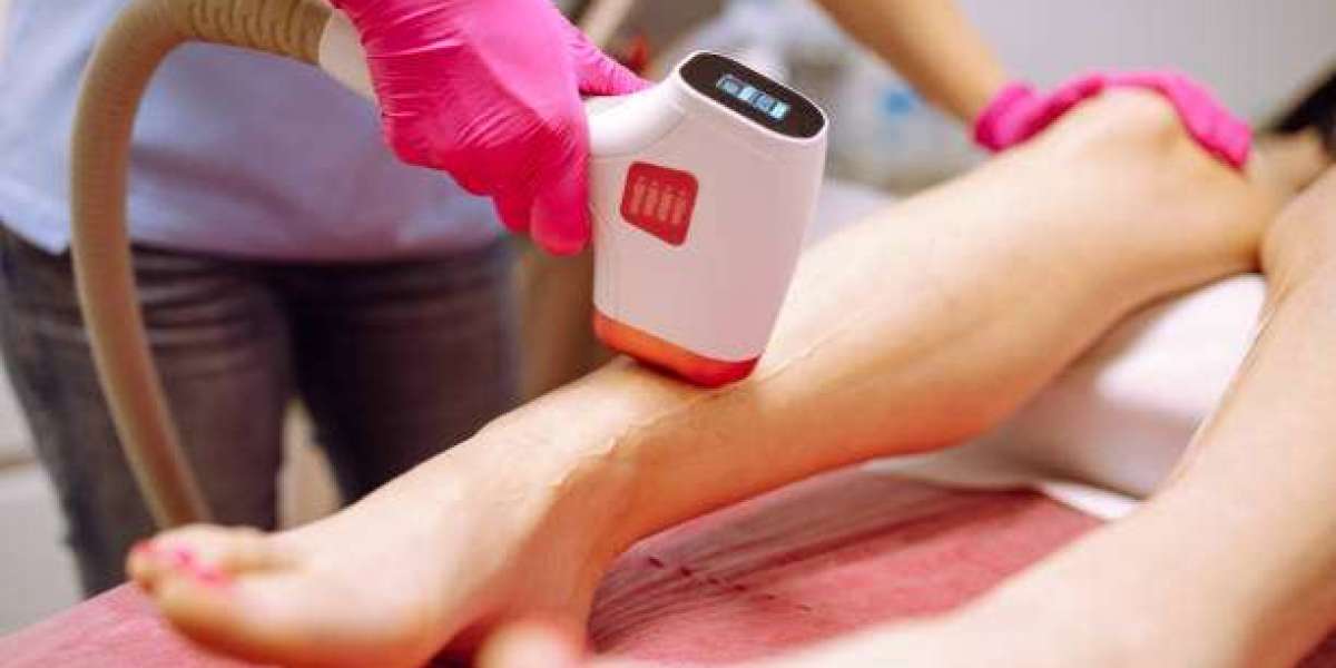 Laser Hair Removal for Legs: Effortless Smoothness Achieved