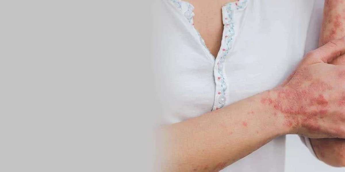 Lifestyle Tips for Managing Psoriasis Flares