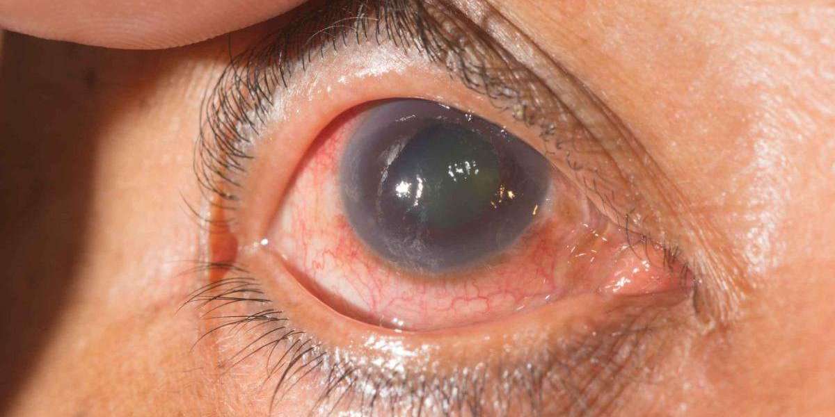 Glaucoma: What It Is, Symptoms, Causes, Types & Treatment