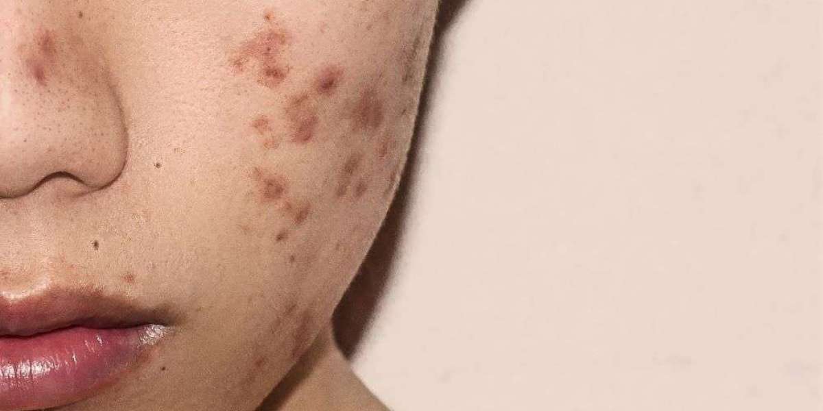 Acne Removal Dubai Tips for Sensitive Skin
