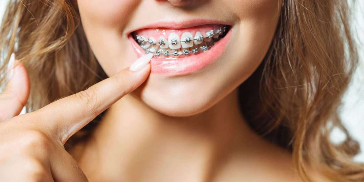 Top 6 Long-Term Health Benefits of Braces