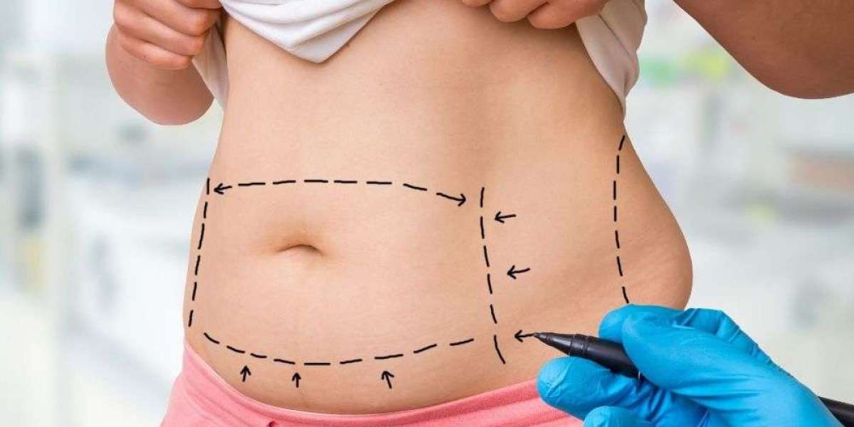 Sculpted Results through Expert Lipo Abdominoplasty