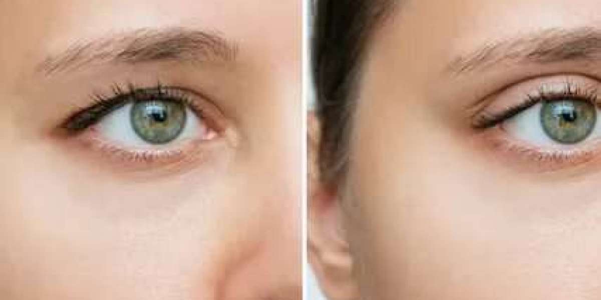 Eyelid Surgery Recovery: Tips for a Smooth Healing Process