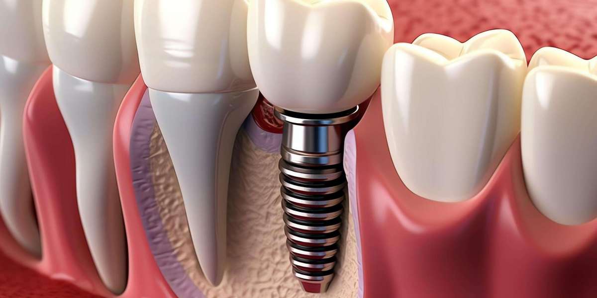 Dental Implant Cost in Baramati: Complete Price Breakdown