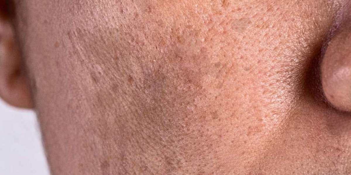 How Effective Are Non-Invasive Pigmentation Treatments?