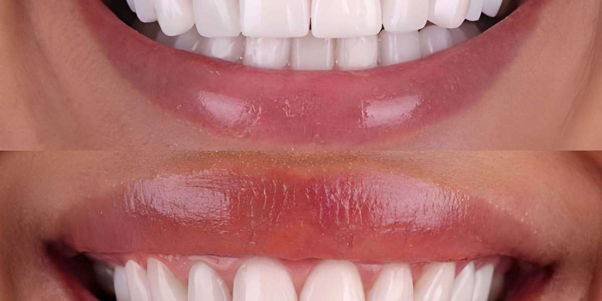 Gum Recontouring Treatment for a Balanced, Confident Smile
