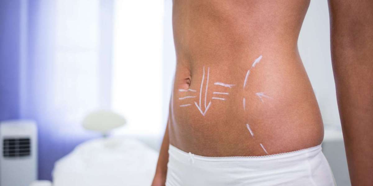 Preparing for a Tummy Tuck Dubai: What Patients Should Know