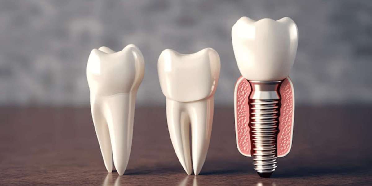 Dental Implants for Seniors: Is Age a Limiting Factor?