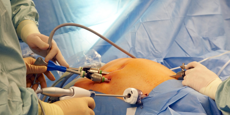 Laparoscopic vs. Robotic Hernia Surgery: Which is Better? : drsaggu — LiveJournal