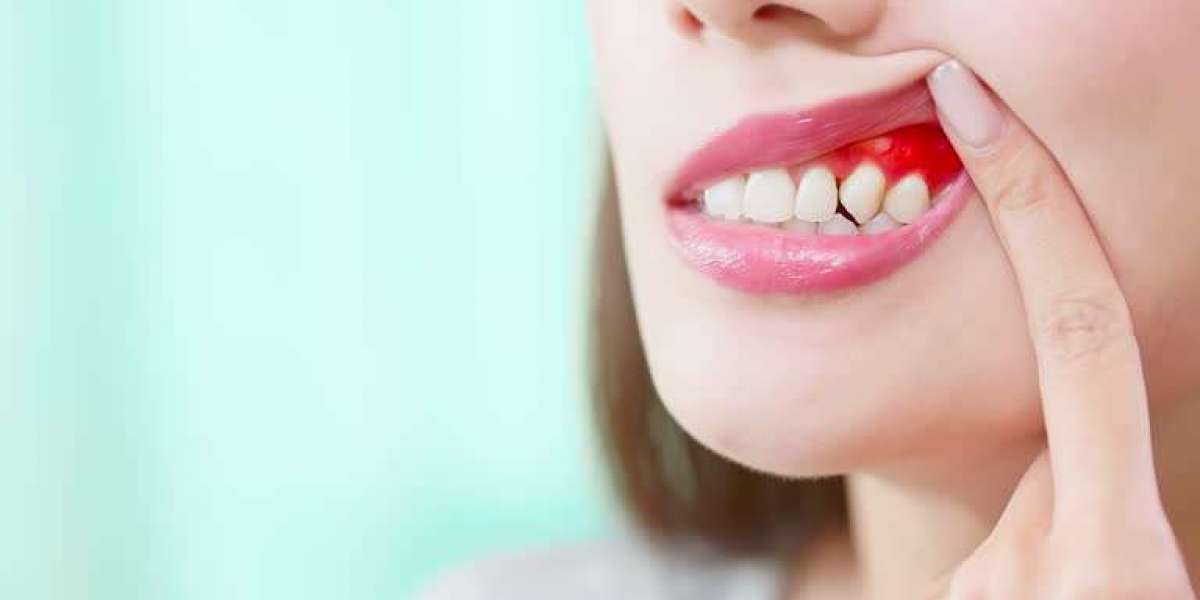 Are Bleeding Gums a Sign of Serious Dental Disease?