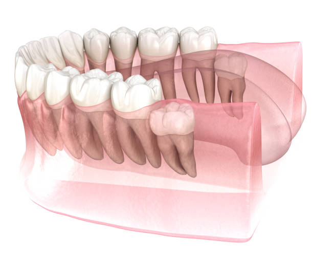 What Happens If You Ignore Wisdom Teeth And Bone Loss In Caldwell? | daddycow.com