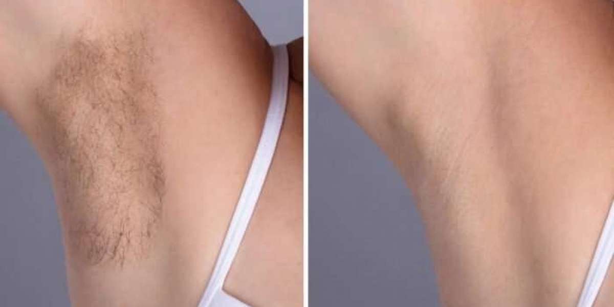 Best Doctors in dubai Offering Safe Electrolysis Laser hair removal