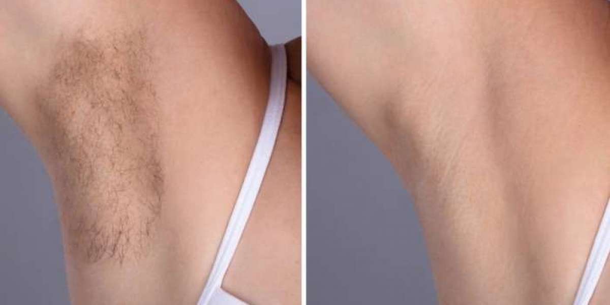 Best Doctors in Dubai Laser Hair Removal with Proven Results
