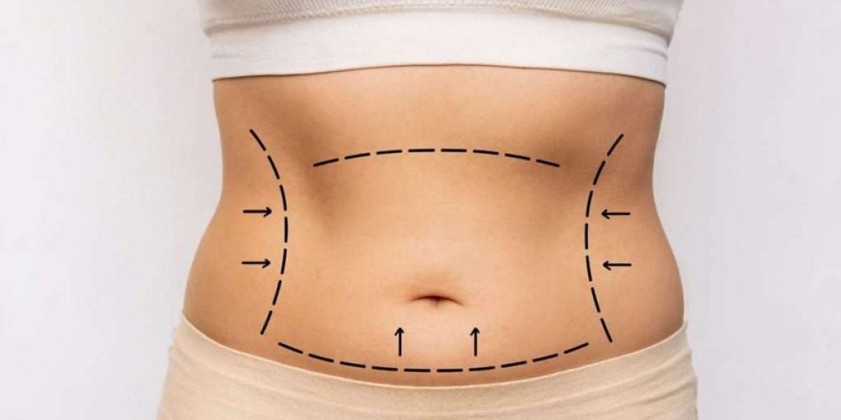 Tummy Tuck Surgery After Weight Loss: What to Expect and Who Is the Right Candidate