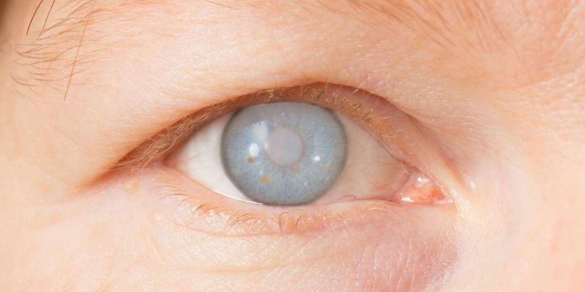 Complete Guide to Cataract Eye Symptoms and Treatment – Arora Eye Centre